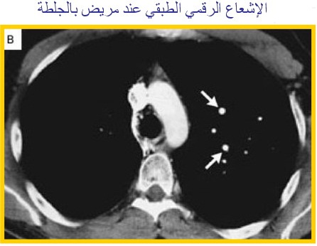 PUMONARY%20EMBOLISM%204.jpg