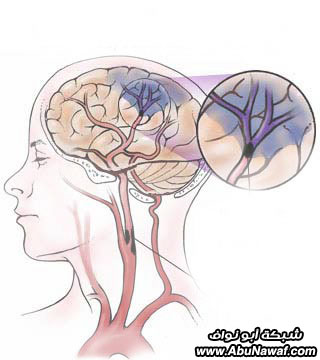 cva-ischemia.jpg