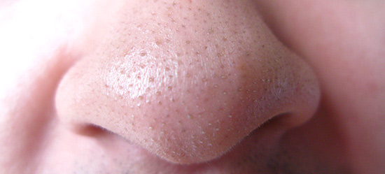 blackheads-nose.jpg