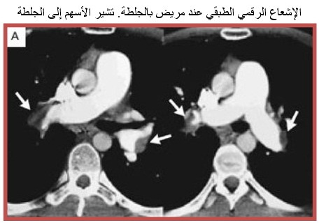 PUMONARY%20EMBOLISM%206.jpg