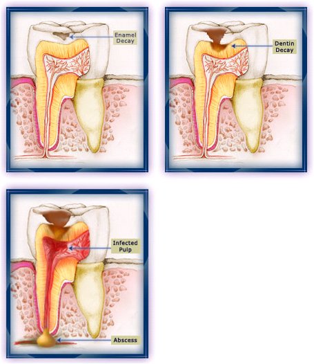 Tooth-Decay.jpg