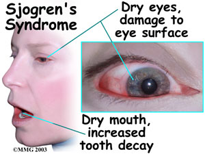 Sjogren_syndrome.jpg