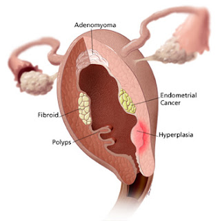 uterine-profile.jpg